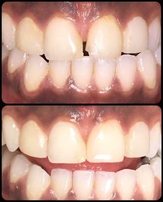 Chipped gap/space between teeth restored with cosmetic dental bonding. 30 minutes, no anesthetic!