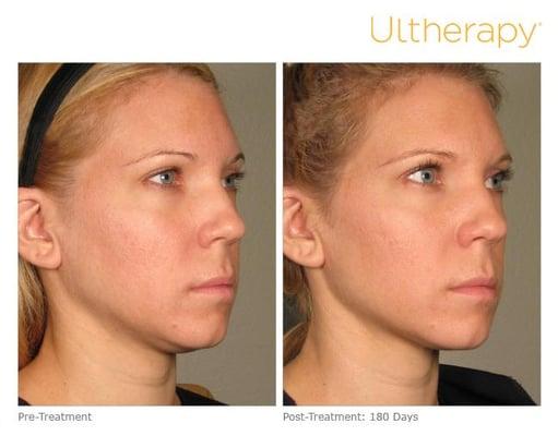 Ultherapy, Ulthera, neck lift, non surgical face lift, face lift visit us @ 2457 N Halsted Chicago, IL 60614