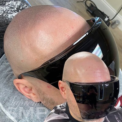 Hair Restoration (Soft & Natural), Scalp Micropigmentation