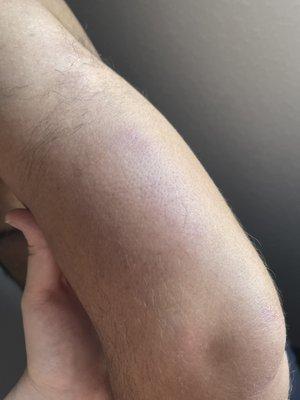 Allergic reaction to bedbug bites