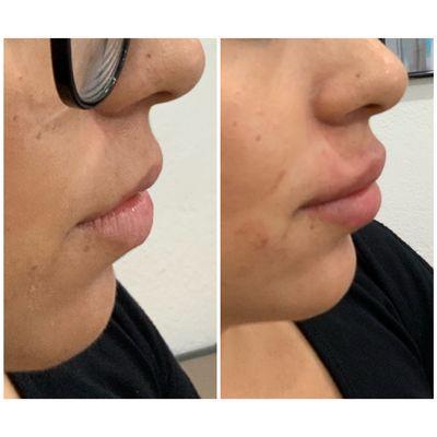 Lip Augmentation Juvederm Ultra Plus XC