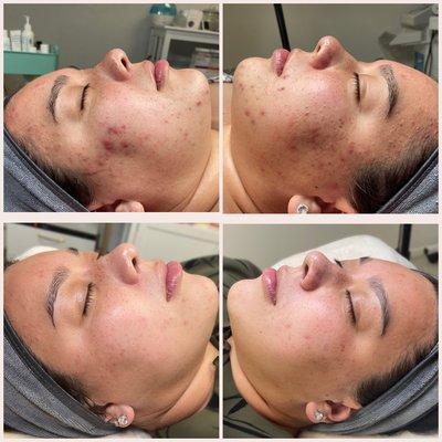 Acne Bootcamp Program