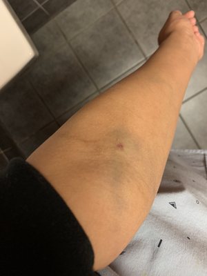 Blood work bruise