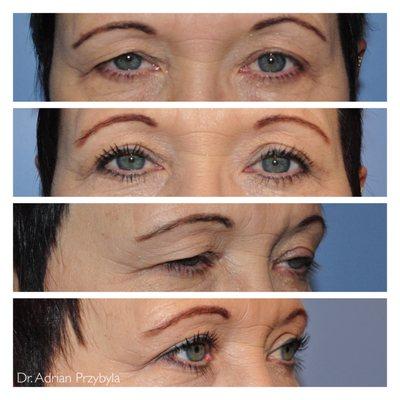 Before & after - Upper eyelid blepharoplasty (eyelid lift) - Performed by Dr. Adrian Przybyla