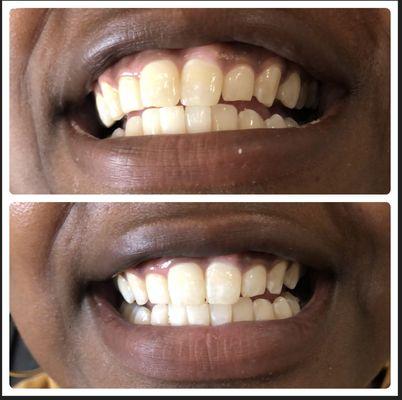 1 session teeth whitening