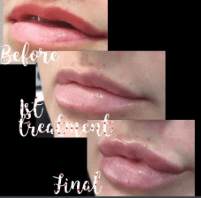 #tranform#valentines#lips#pump#enhance#aesthetics#dermalfillers#beautyindustryprofessionals