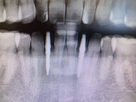 Implants for missing teeth