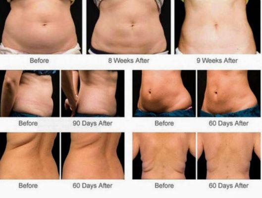 We have great results for our body contouring and slimming system.