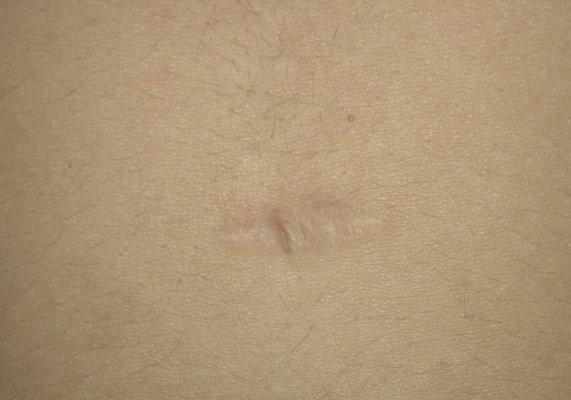 Scar with hole from mole removal