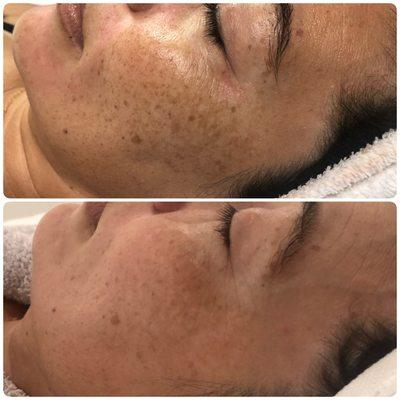 Microneedling results