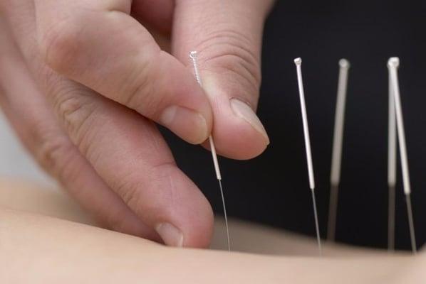 Medical Acupuncture