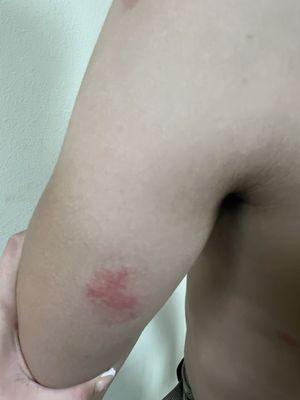 Bed bug bites