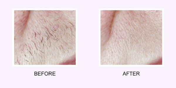 Laser hair removal