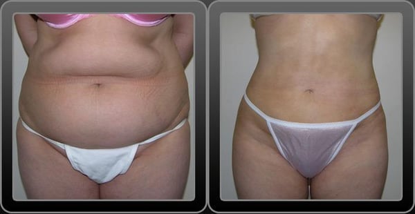 Liposuction Before & After