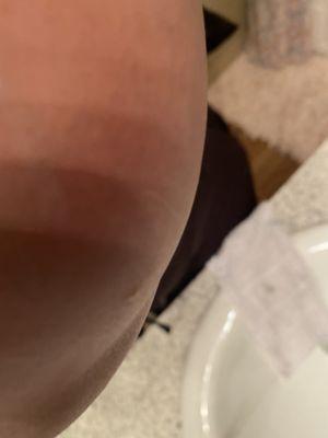 More bed bug bites on my arms