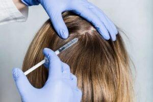 PRP for thinning hair