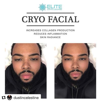 Amazing results right after first cryo facial session