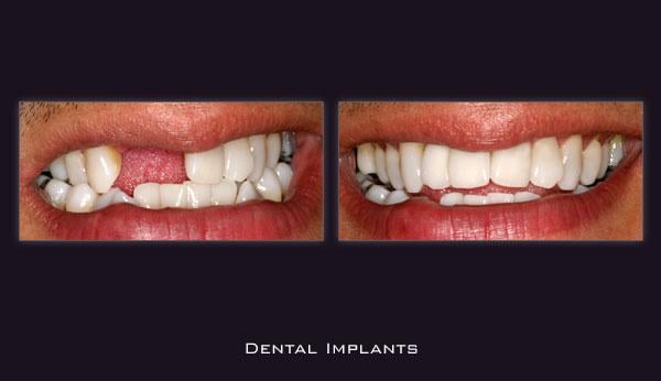 Dental Implants in Brooklyn