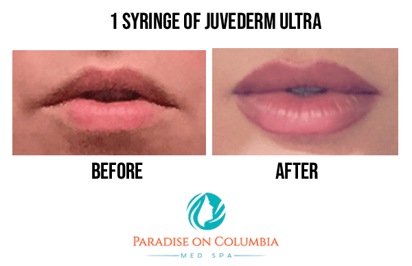 Fillers before and after