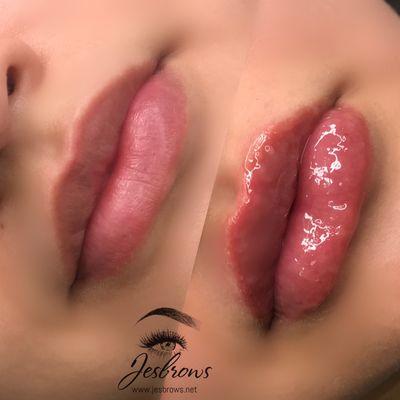 1ml Lip fillers