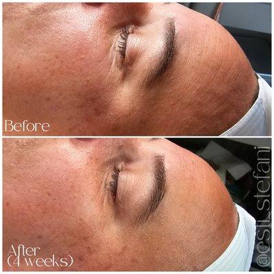 Loving this progress from one Microneedling Treatment. Both photos were taken of clean skin pre-treatment, 4 weeks apart.