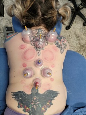 What cupping looks like!