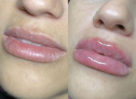 2 ML Lip Filler