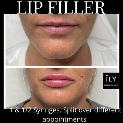 Lip filler!