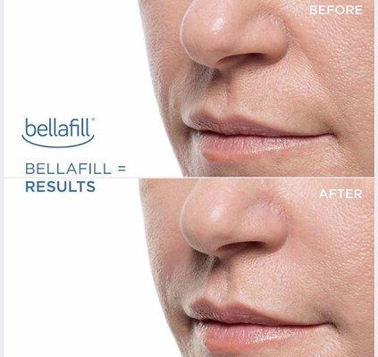 BellaFill 5 year long filler, great for age correction and acne scars