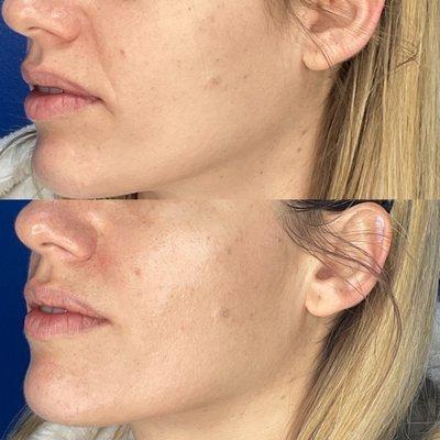 Smile lines after 1 syringe juvederm filler