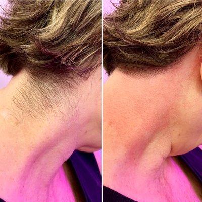 Before and after of neck sugar hair removal