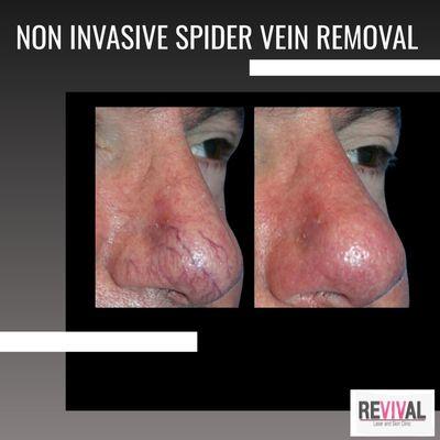 Spider Vein Removal using the most advanced technology on the market!