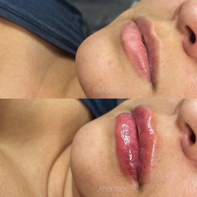 Lip Filler before and after. Check out our Instagram @cloud9beautylab Text 562-375-8234 to book