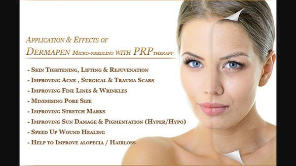 PRP offered at Anew Medspa Brecksville!