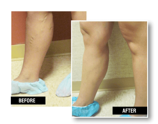 Healthy and beautiful legs happen at USA Vein Clinics