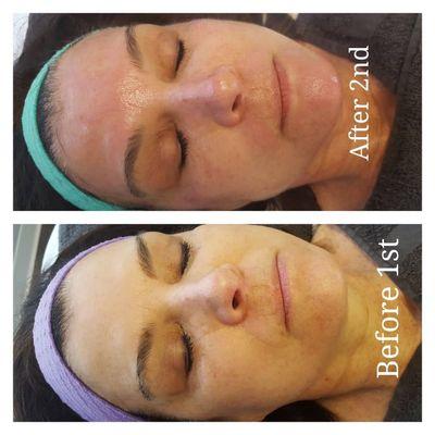 Microneedling before and after!!