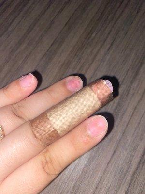 Natural nails are bleeding and acrylic wasn't removed properly