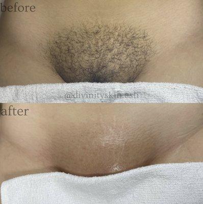 Brazilian wax! Before and after.