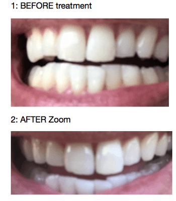 yo look at those teef! before and after zoom. ps no veneers or nothing. (and no cavities. brush yo' teeth!)