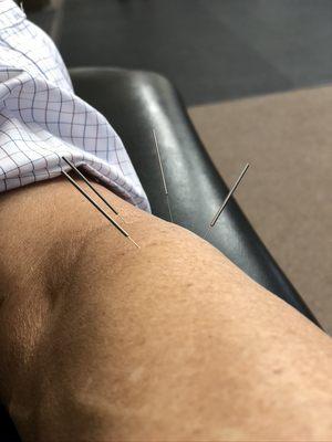 We offer trigger point, intramuscular dry needling to help manage overuse muscle and tendon injuries.