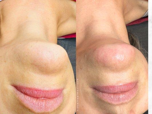 Electrolysis on chin