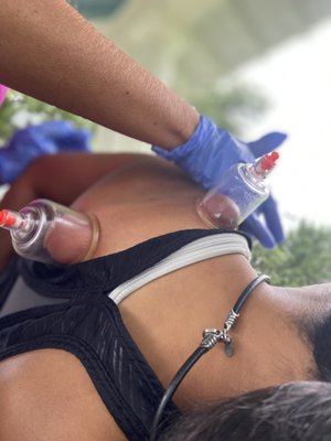 Recover like Michael Phelps with Therapeutic Cupping