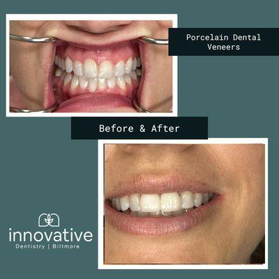 Dental bonding can wear out, stain and chip over time. Porcelain dental veneers at Innovative Dentistry Biltmore