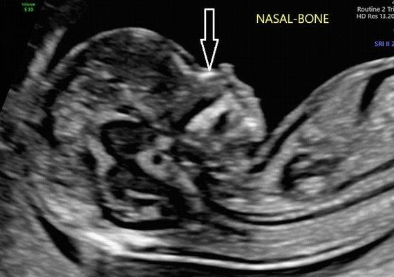 13 weeks nasal bone image