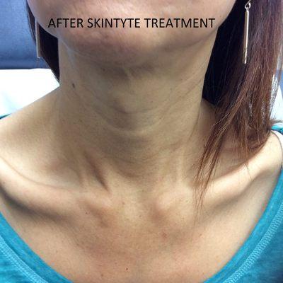 After SKINTYTE Treatment