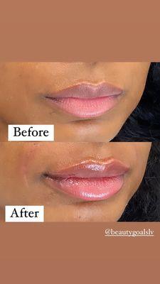 Lip filler before and after