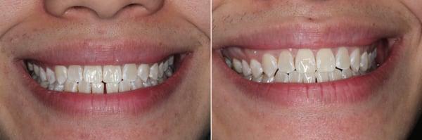 Before and After of Invisalign