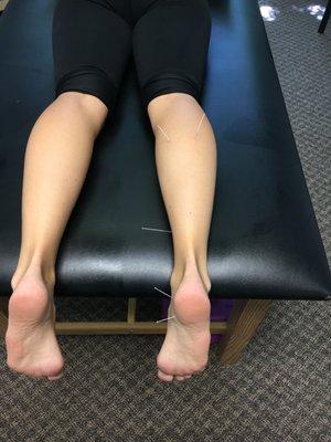 Dry needling for a posterior tibialis tendon issue!