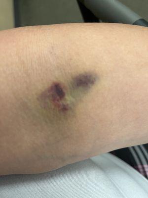 Bruise from having blood withdrawn last week.