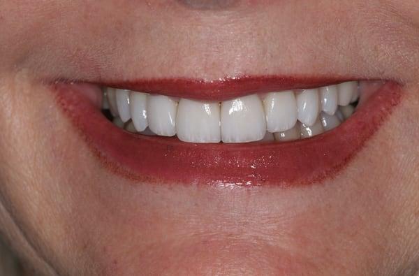 AFTER- Crowns and veneers